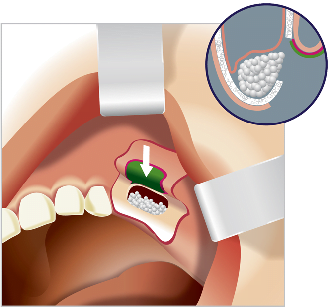 Dental Implants-Sinus lift