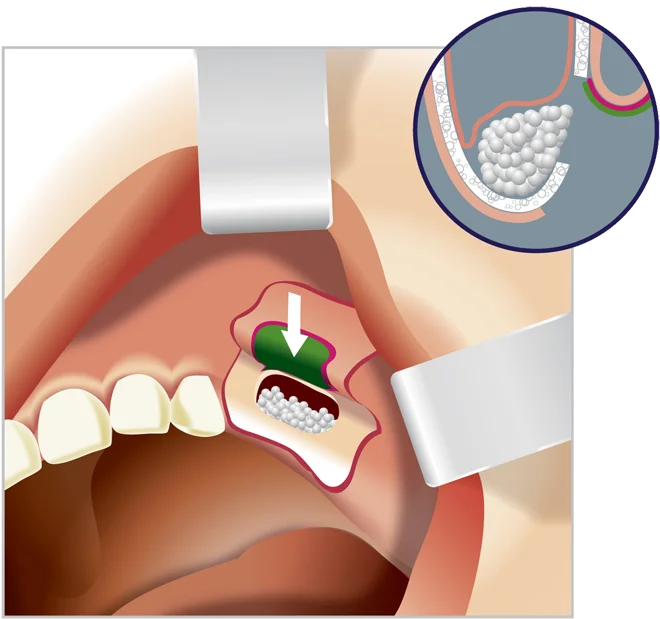 Dental Implants-Sinus lift