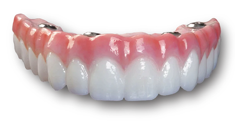 Full Mouth Implant