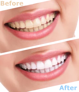 Teeth whitening