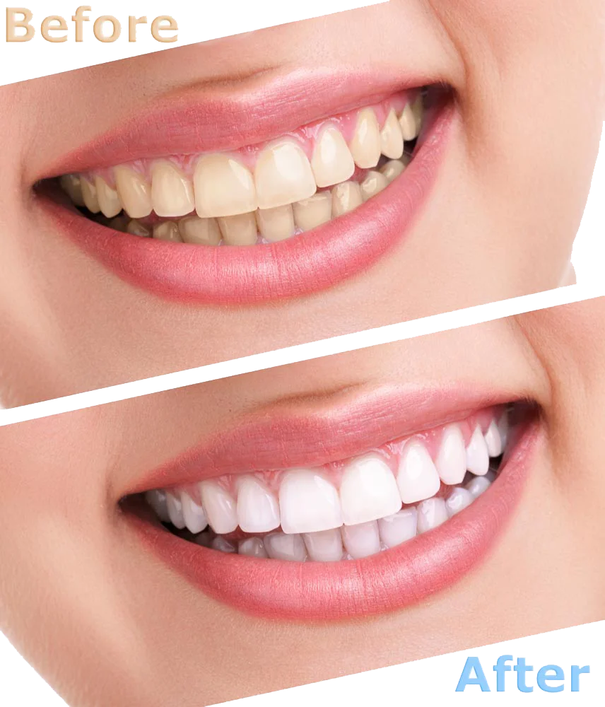 Teeth whitening
