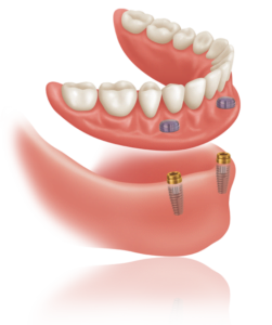 Implant supported over denture