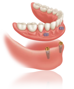 Implant supported over denture