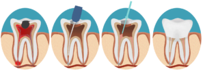 Root Canal Treatment