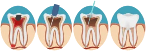 Root Canal Treatment