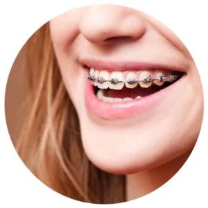Metal Braces