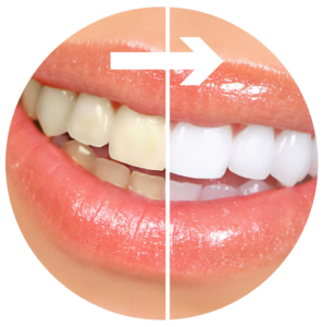 Cosmetic dentistry