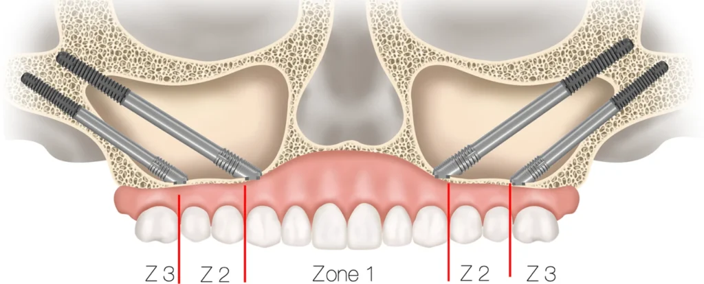 Zygoma Implants