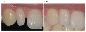 Gem Dentistry- biomimetics