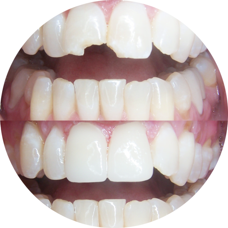 Dental Veneers