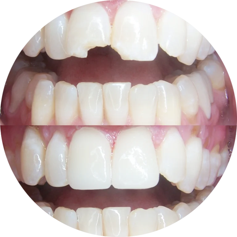 Dental Veneers