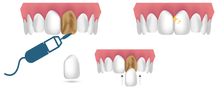 Dental Veneers