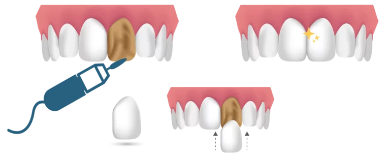 Dental Veneers