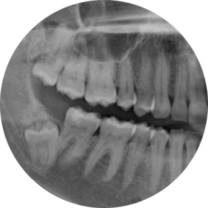 wisdom tooth - gem dental clinic