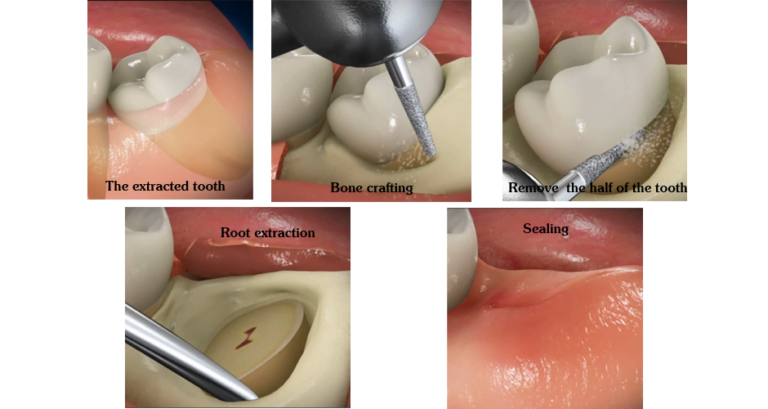 Wisdom teeth removal