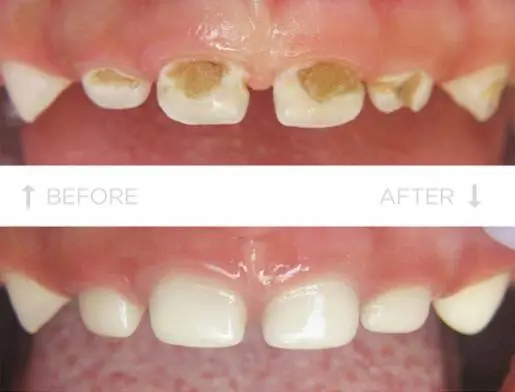 kids dentistry in gem dental clinic