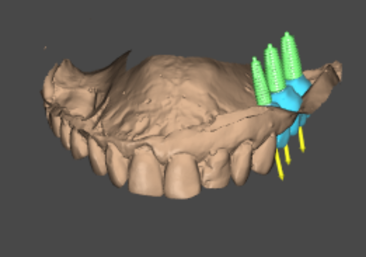 3D implant planning /gem dentistry